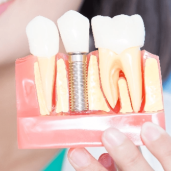 dental implant example model of a dental implant