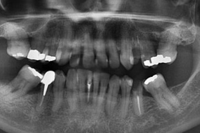 dental x-ray example of a dental x-ray