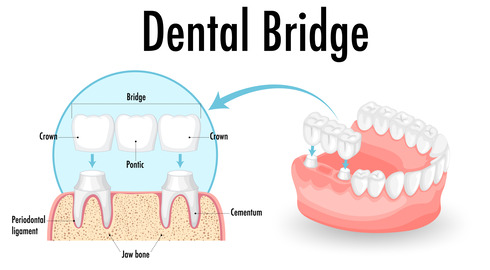 illustration of a dental bridge