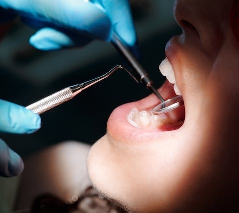 nitrous oxide dentistry with nitric oxide