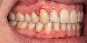 gums with gum disease